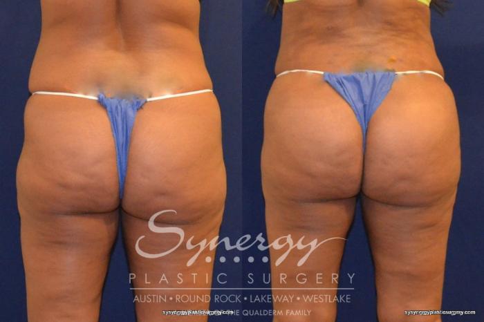 Before & After Buttock Augmentation/Brazilian Butt Lift Case 226 View #2 View in Austin, TX