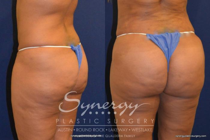 Before & After Buttock Augmentation/Brazilian Butt Lift Case 226 View #3 View in Austin, TX