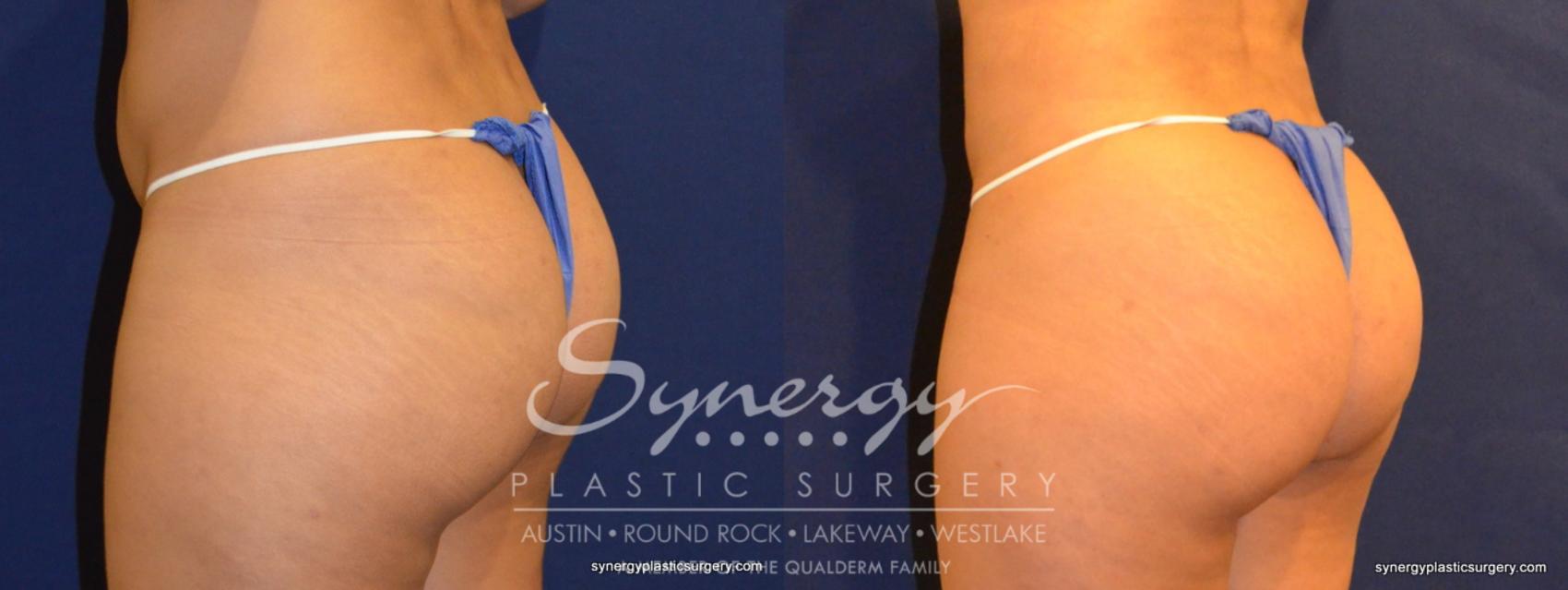 Before & After  Case 257 View #1 View in Austin, TX