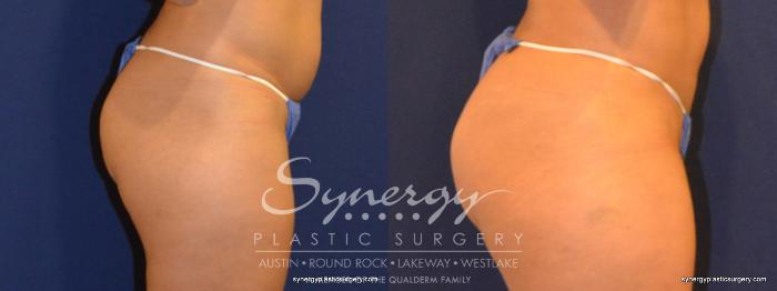 Before & After  Case 257 View #3 View in Austin, TX