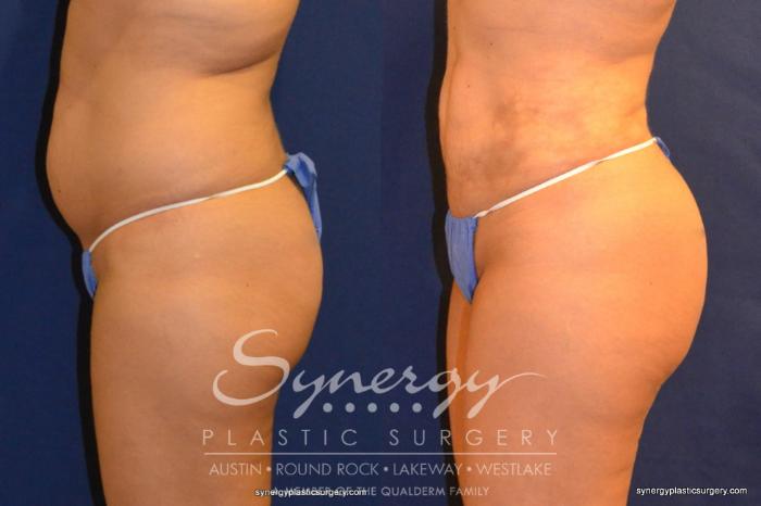 Before & After Buttock Augmentation/Brazilian Butt Lift Case 258 View #2 View in Austin, TX