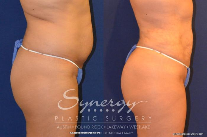 Before & After Buttock Augmentation/Brazilian Butt Lift Case 258 View #7 View in Austin, TX