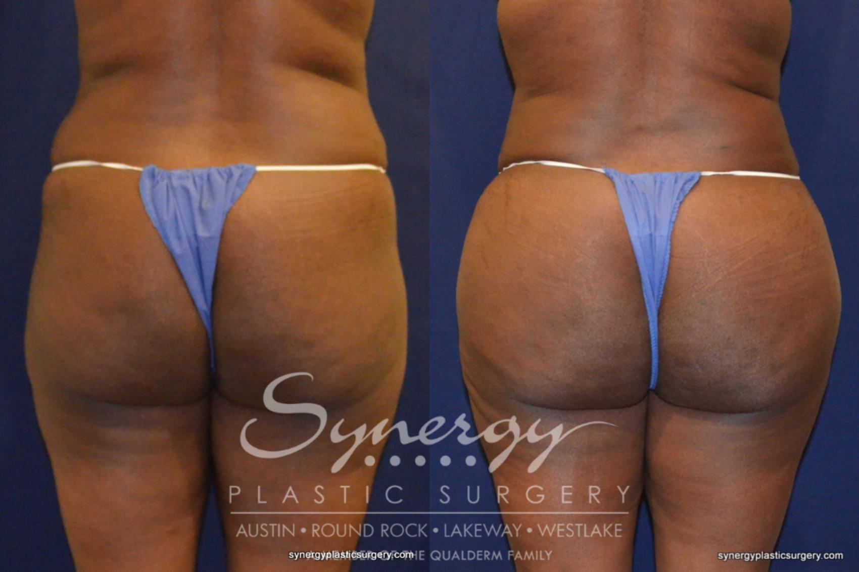 Before & After Buttock Augmentation/Brazilian Butt Lift Case 262 View #1 View in Austin, TX