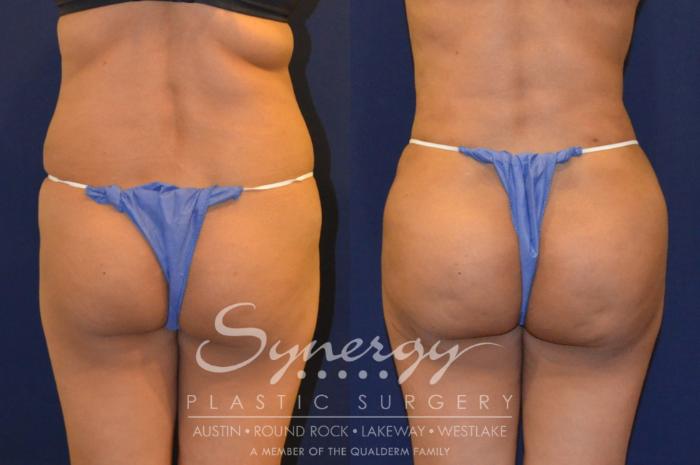 Before & After  Case 291 View #1 View in Austin, TX