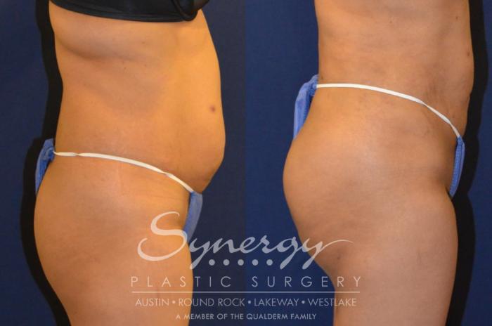 Before & After  Case 291 View #2 View in Austin, TX