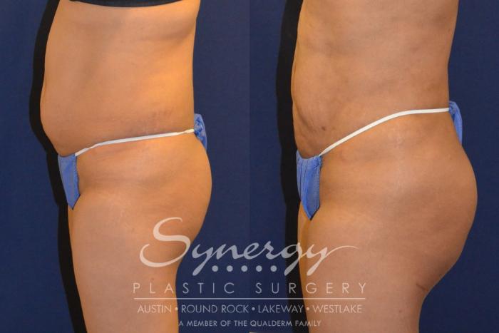 Before & After  Case 291 View #4 View in Austin, TX