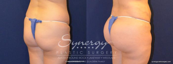 Before & After  Case 338 View #2 View in Austin, TX