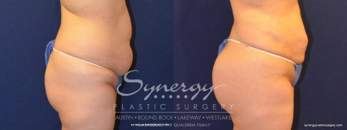 Before & After  Case 338 View #4 View in Austin, TX