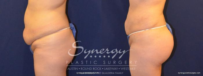 Before & After  Case 338 View #5 View in Austin, TX