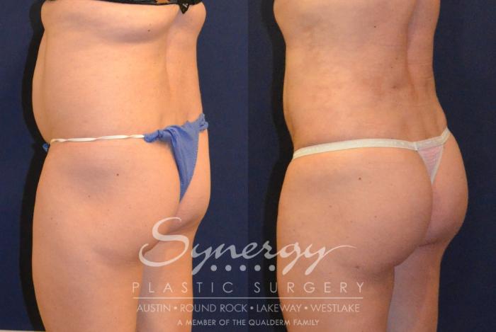 Before & After Buttock Augmentation/Brazilian Butt Lift Case 383 View #1 View in Austin, TX