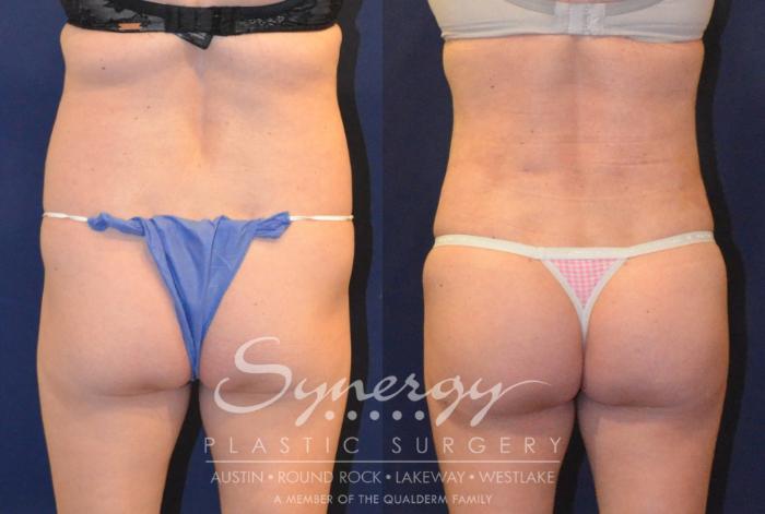 Before & After Buttock Augmentation/Brazilian Butt Lift Case 383 View #2 View in Austin, TX