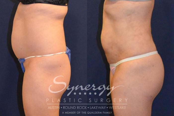 Before & After Buttock Augmentation/Brazilian Butt Lift Case 383 View #3 View in Austin, TX