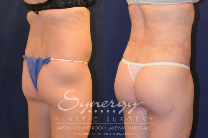Before & After Buttock Augmentation/Brazilian Butt Lift Case 383 View #4 View in Austin, TX