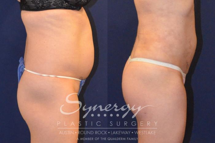 Before & After Buttock Augmentation/Brazilian Butt Lift Case 383 View #5 View in Austin, TX