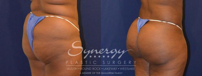 Before & After Buttock Augmentation/Brazilian Butt Lift Case 387 View #2 View in Austin, TX