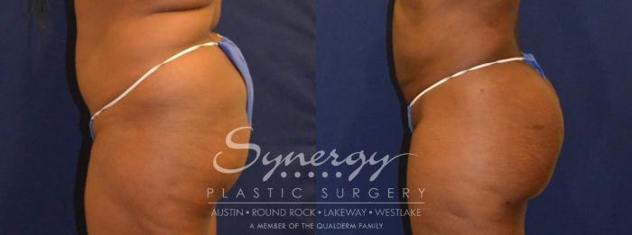 Before & After Buttock Augmentation/Brazilian Butt Lift Case 387 View #4 View in Austin, TX
