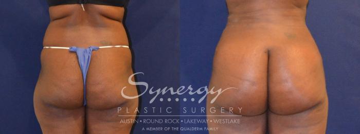 Before & After Buttock Augmentation/Brazilian Butt Lift Case 391 View #1 View in Austin, TX