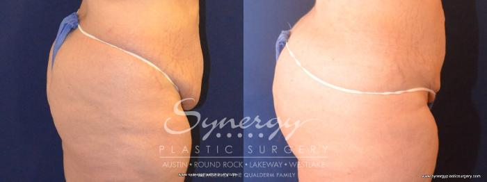 Before & After Buttock Augmentation/Brazilian Butt Lift Case 418 View #2 View in Austin, TX
