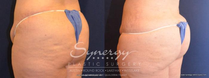 Before & After Buttock Augmentation/Brazilian Butt Lift Case 418 View #5 View in Austin, TX
