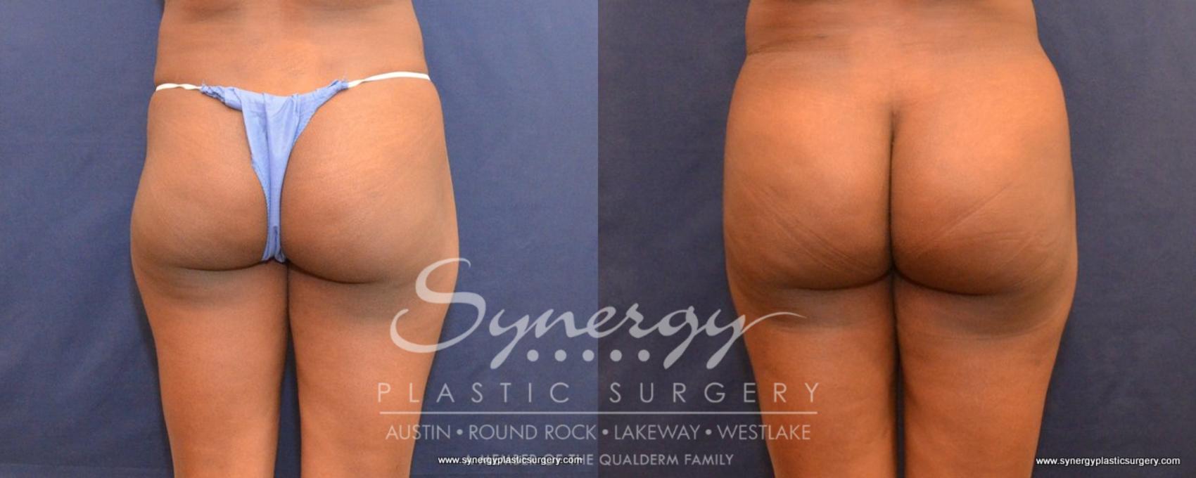 Before & After  Case 497 View #1 View in Austin, TX