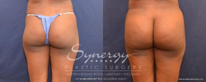 Before & After Buttock Augmentation/Brazilian Butt Lift Case 497 View #1 View in Austin, TX