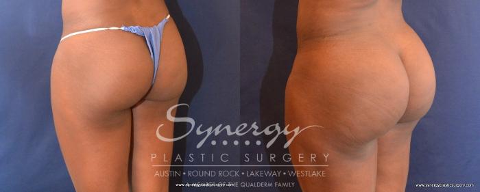 Before & After  Case 497 View #2 View in Austin, TX