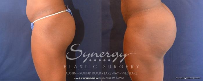 Before & After  Case 497 View #4 View in Austin, TX