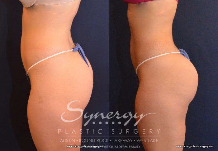 Before & After Buttock Augmentation/Brazilian Butt Lift Case 593 View #1 View in Austin, TX