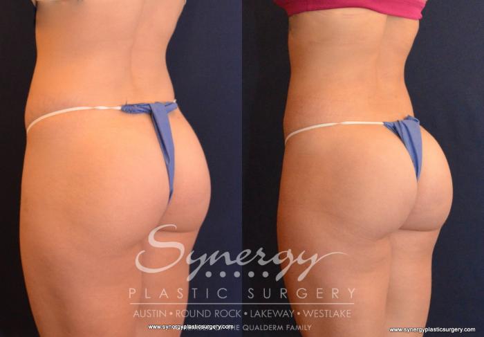 Before & After  Case 593 View #2 View in Austin, TX