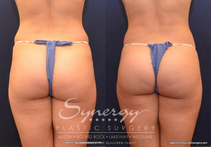 Before & After  Case 593 View #3 View in Austin, TX