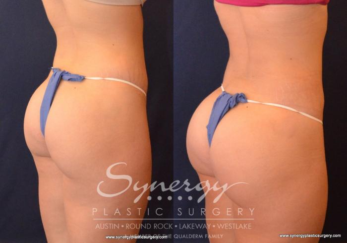 Before & After  Case 593 View #4 View in Austin, TX