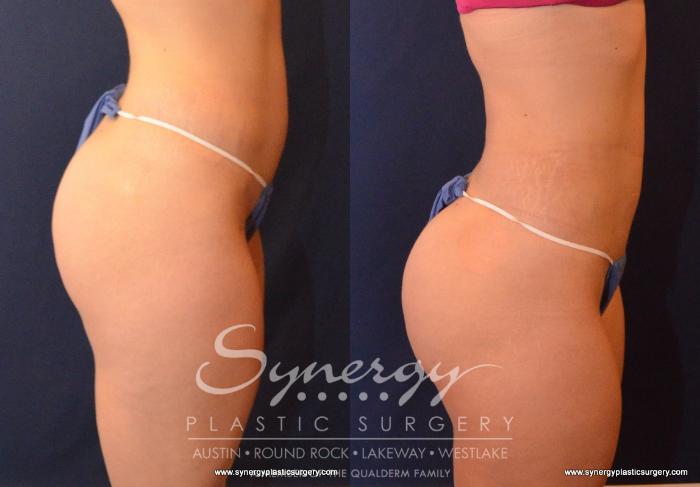 Before & After  Case 593 View #5 View in Austin, TX