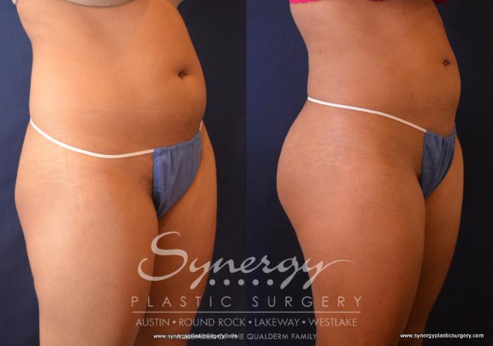 Before & After Buttock Augmentation/Brazilian Butt Lift Case 716 View #1 View in Austin, TX