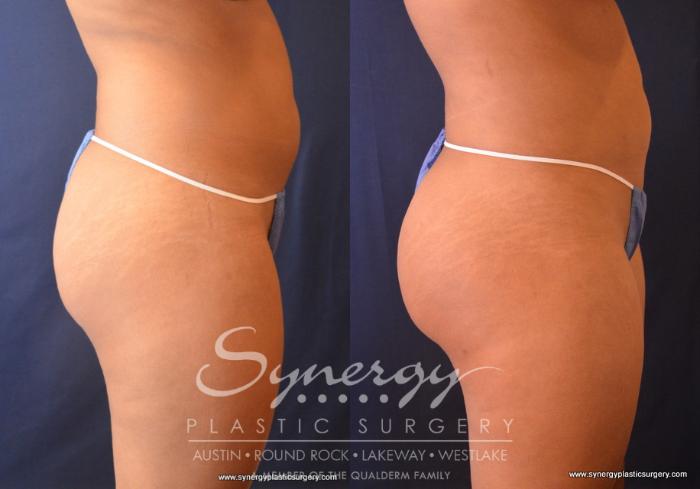 Before & After  Case 716 View #2 View in Austin, TX