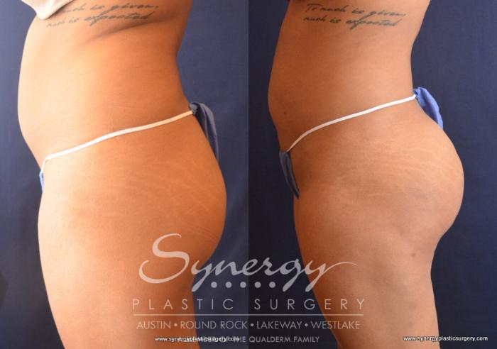 Before & After  Case 716 View #5 View in Austin, TX