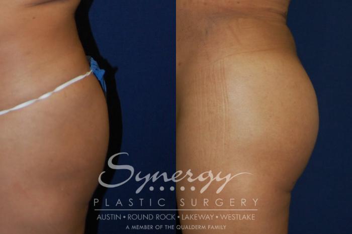 Before & After Buttock Augmentation/Brazilian Butt Lift Case 90 View #2 View in Austin, TX