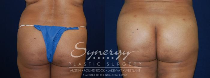 Before & After Buttock Augmentation/Brazilian Butt Lift Case 90 View #4 View in Austin, TX