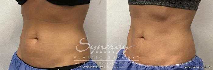 Before & After CoolSculpting® Case 762 View #2 View in Austin, TX