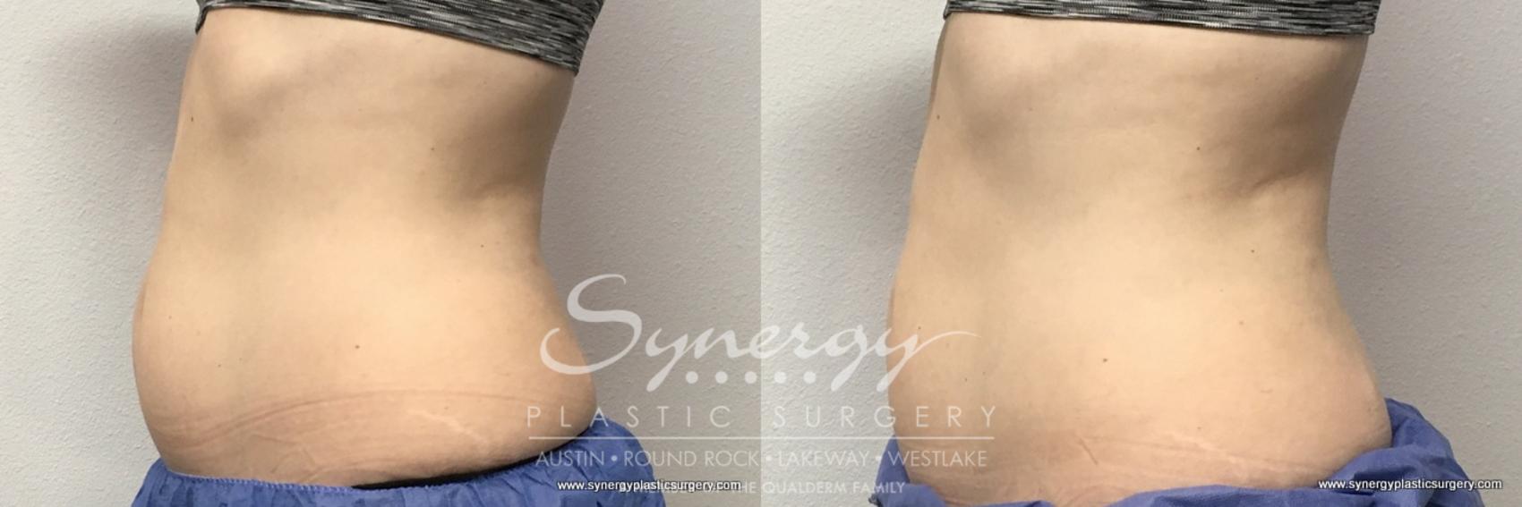 Before & After CoolSculpting® Case 763 View #1 View in Austin, TX