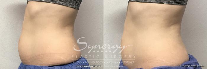 Before & After CoolSculpting® Case 763 View #1 View in Austin, TX