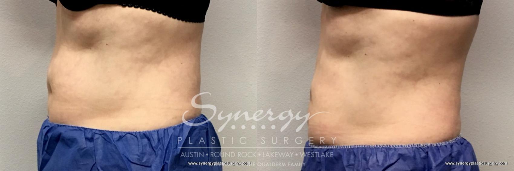 Before & After CoolSculpting® Case 765 View #1 View in Austin, TX