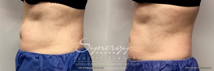 Before & After CoolSculpting® Case 765 View #1 View in Austin, TX