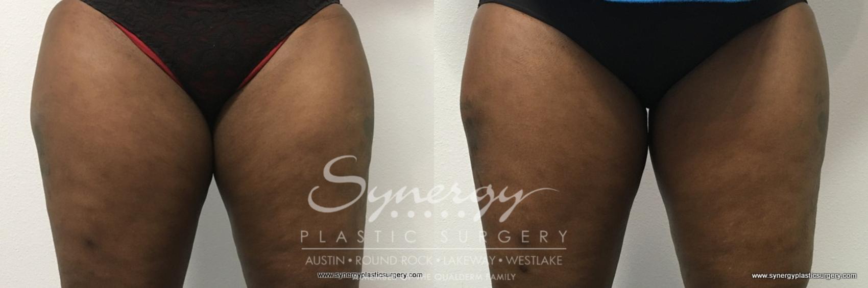 Before & After CoolSculpting® Case 767 View #1 View in Austin, TX