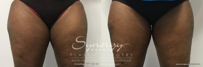 Before & After CoolSculpting® Case 767 View #1 View in Austin, TX