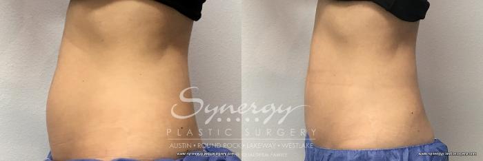 Before & After  Case 769 View #2 View in Austin, TX