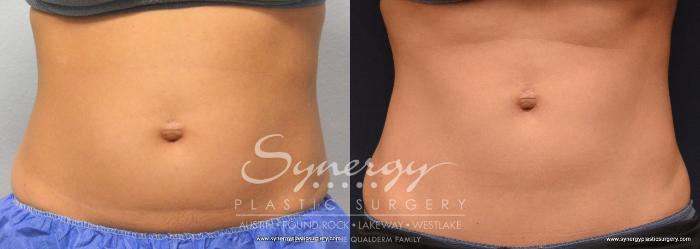 Before & After  Case 770 View #1 View in Austin, TX