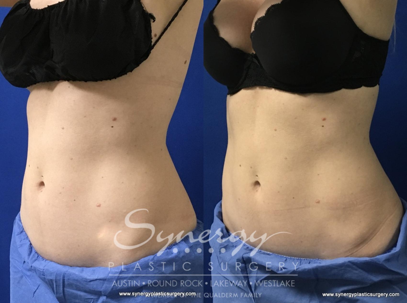 Before & After CoolSculpting® Case 774 View #1 View in Austin, TX