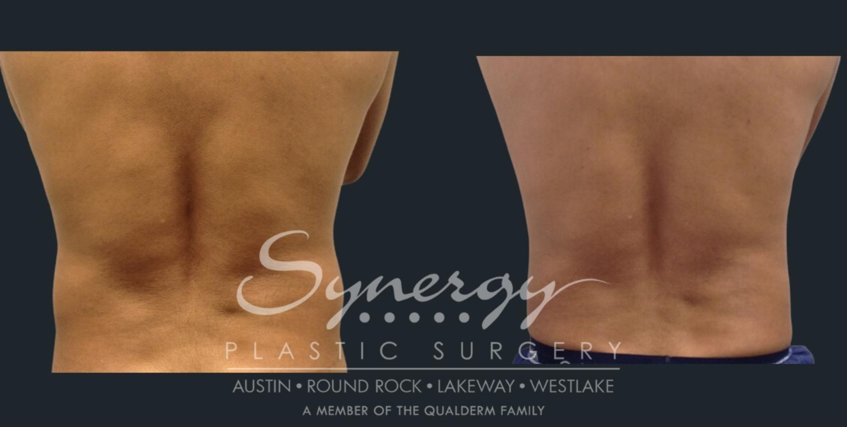 coolsculpting treatment