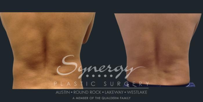 coolsculpting treatment