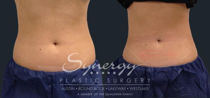 coolsculpting treatment